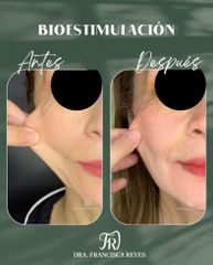 Bioestimulación Facial - Dra. Francisca Reyes