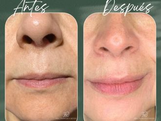 Aumento de labios antes y después - 875494