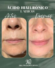 Ácido hialurónico - Labios - Dra. Francisca Reyes