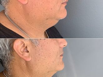 Lipopapada antes y después - 878083