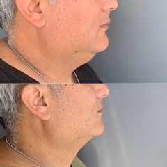 Lipopapada - Dra. Francisca Reyes