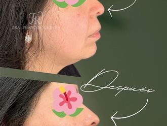 Ácido hialurónico antes y después - 878084