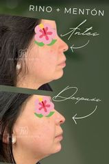 Rinomodelación + mentón con Ácido Hialurónico