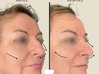 Armonización facial antes y después - 878511