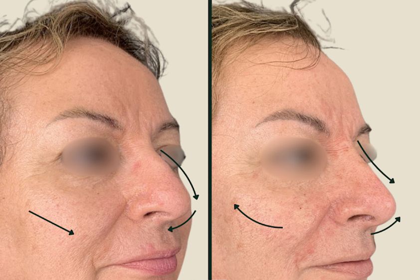 Armonización facial antes y después - 878511