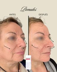 Armonización Facial - Dra. Francisca Reyes