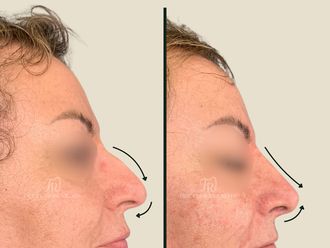 Rinomodelación antes y después - 878512