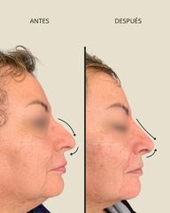 Rinomodelación - Dra. Francisca Reyes