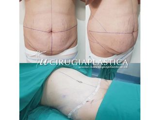 Abdominoplastia - 643719