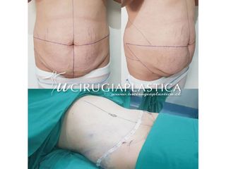 Abdominoplastia