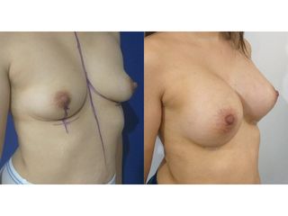 Aumento mamario