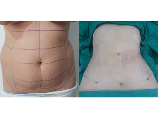 Liposucción