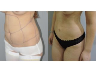 Liposucción
