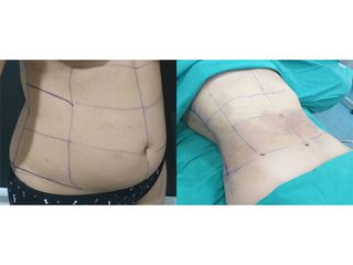 Liposucción