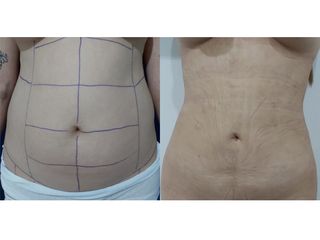 Liposucción