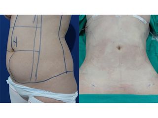 Liposucción