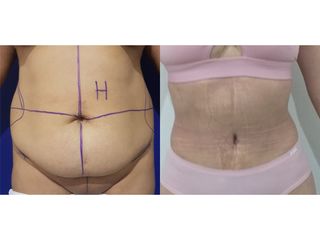 Abdominoplastia