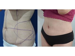 Abdominoplastia