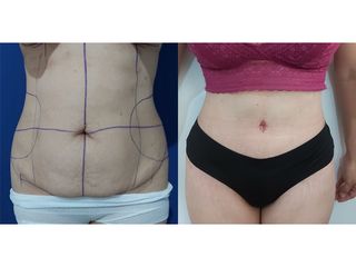 Abdominoplastia