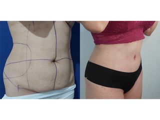 Abdominoplastia