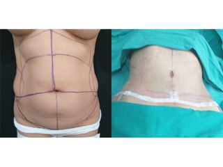 Abdominoplastia