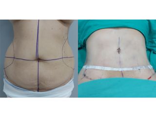 Abdominoplastia