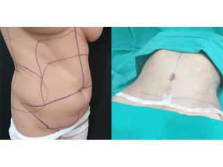 Abdominoplastia