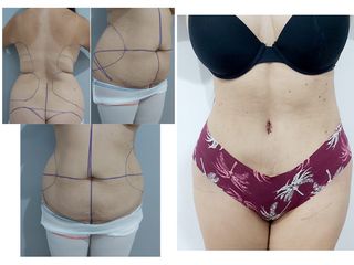 Abdominoplastia