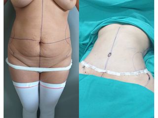 Abdominoplastia