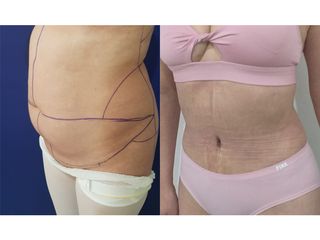 Abdominoplastia