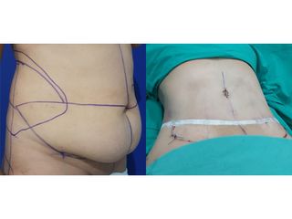 Abdominoplastia