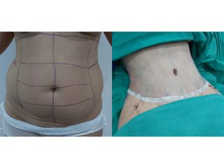 Abdominoplastia