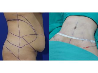 Abdominoplastia