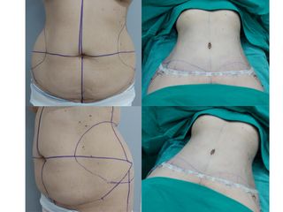 Abdominoplastia