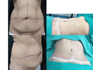 Abdominoplastia