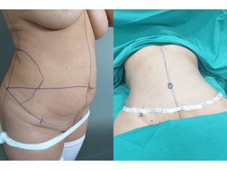 Abdominoplastia
