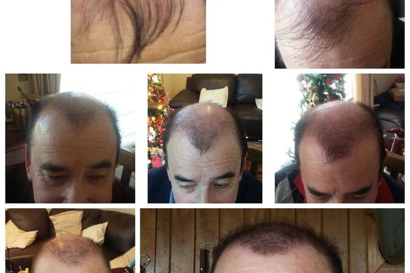 Alopecia antes y después - 638266