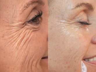 Rejuvenecimiento facial antes y después - 869531