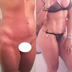Liposuccion - Dr. Carlos Figueroa R