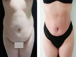 Lipoabdominoplastia