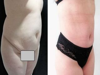 Lipoabdominoplastia