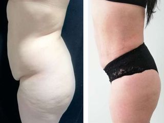 Lipoabdominoplastia