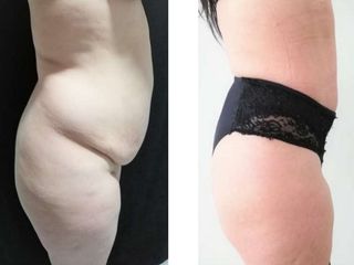 Lipoabdominoplastia