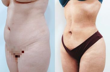 Liposucción - Dr. Carlos Figueroa R