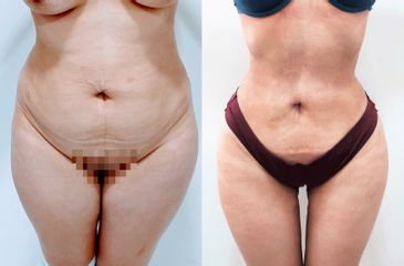 Liposucción - Dr. Carlos Figueroa R