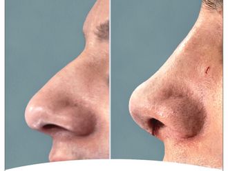 Rinoplastia - 791041