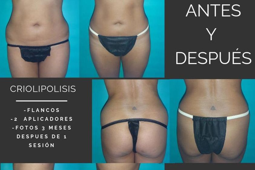 Criolipólisis antes y después - 634863
