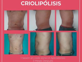 Criolipolisis en Hombres
