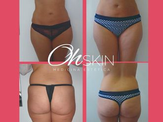Mesoterapia - 634866