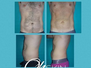 Criolipolisis en Hombres